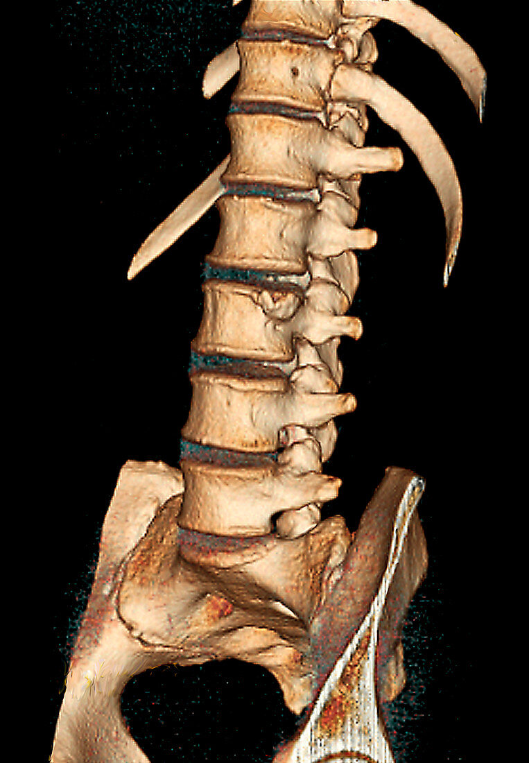 Spinal bone protrusion,3D CT scan