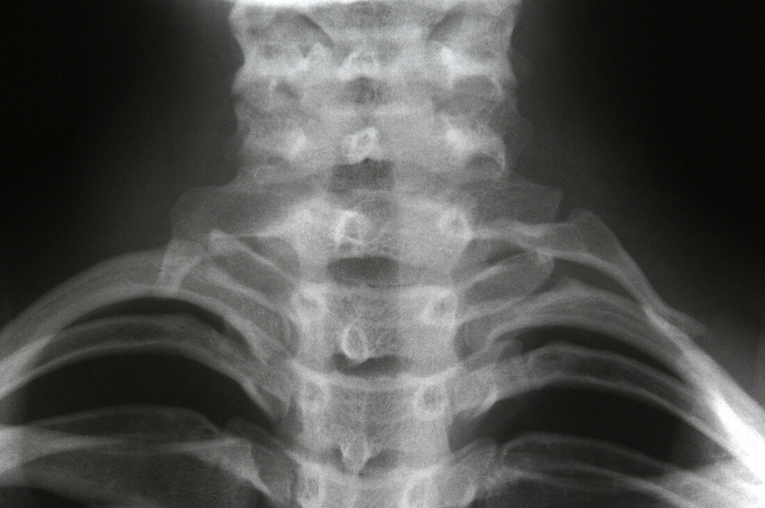 Cervical ribs,X-ray