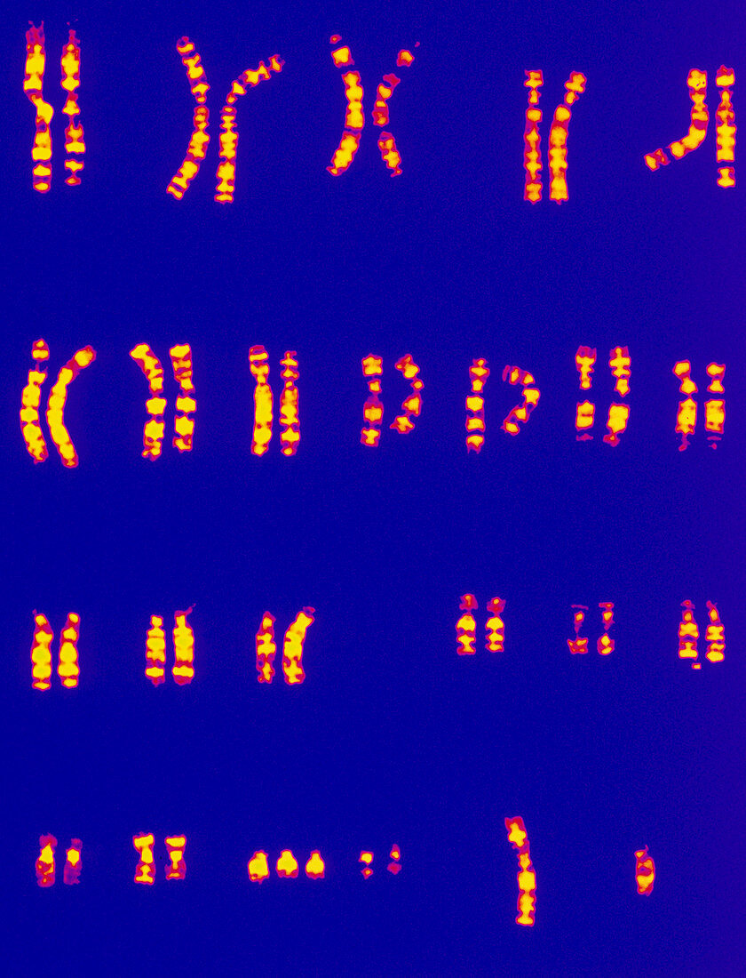 Col karyotype of chromosomes in Down's syndrome