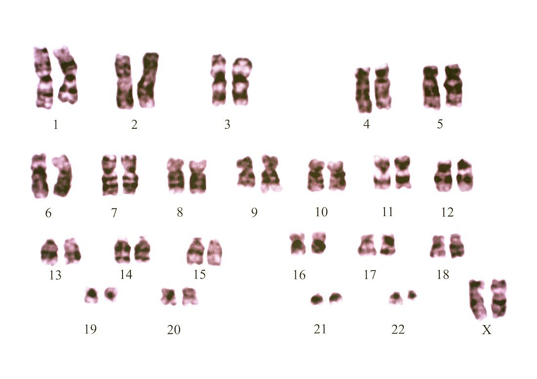 Philadelphia chromosome