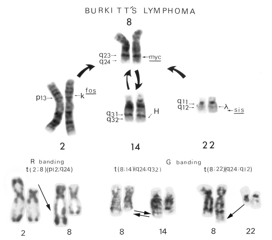 Burkitt's lymphoma