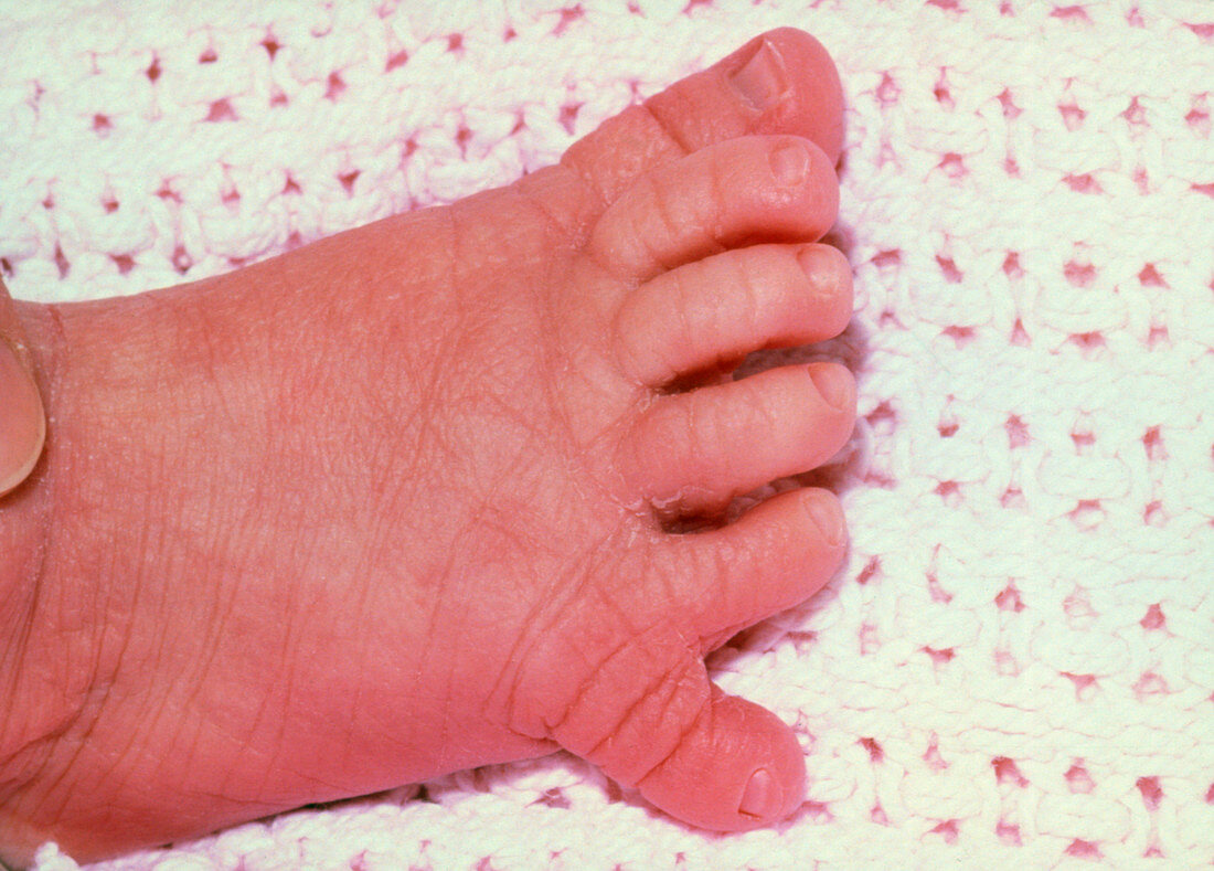 Infant with six toes (supernumary)