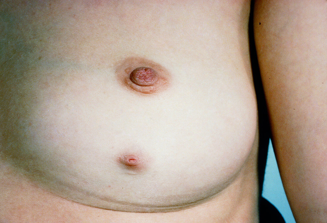 Ectopic nipple of a female