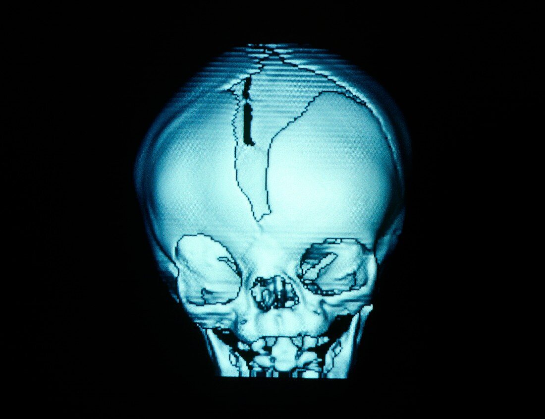 3-D CT scan of infant with deformed skull