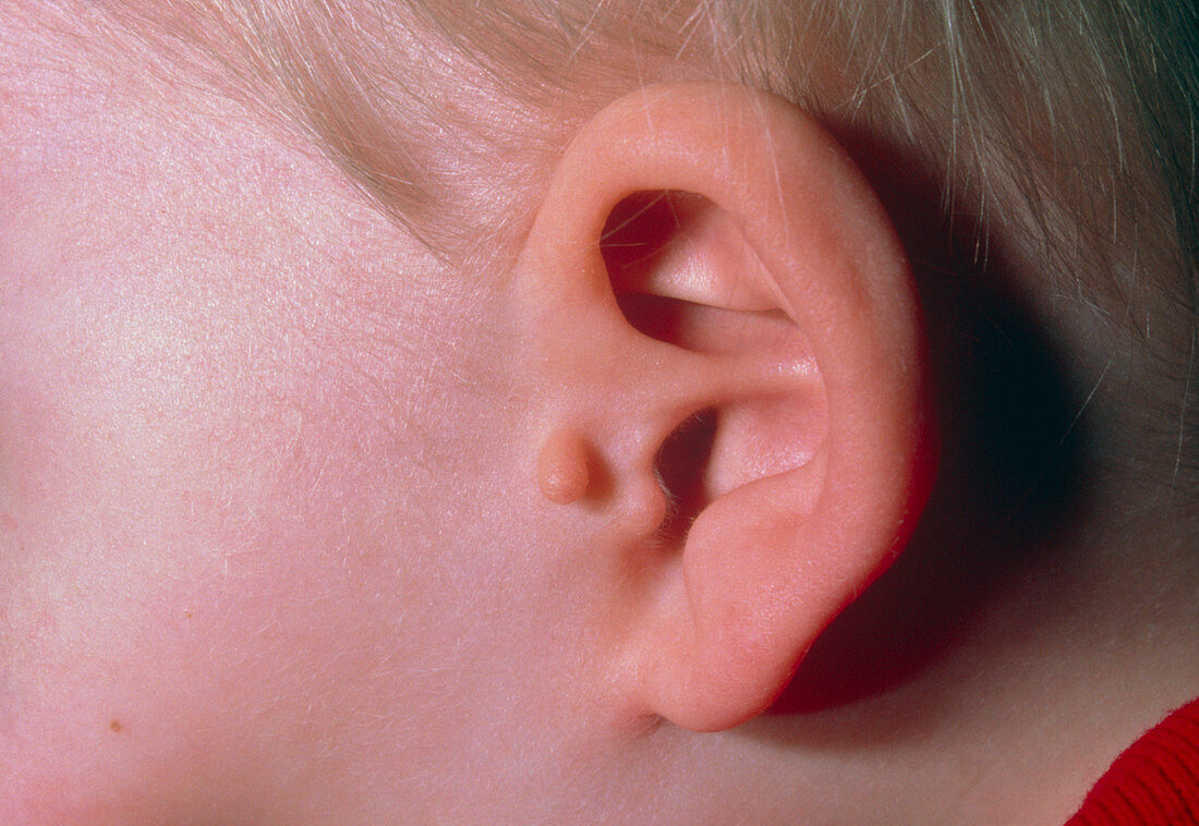 Auricular (ear) appendage: a congenital deformity