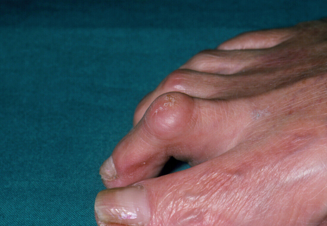 Hammer toe: deformity of second toe with corns