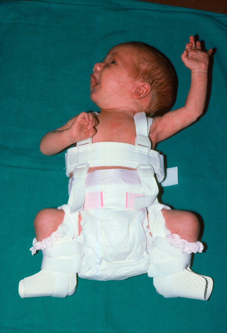 A newborn baby affected by dislocation of the hip
