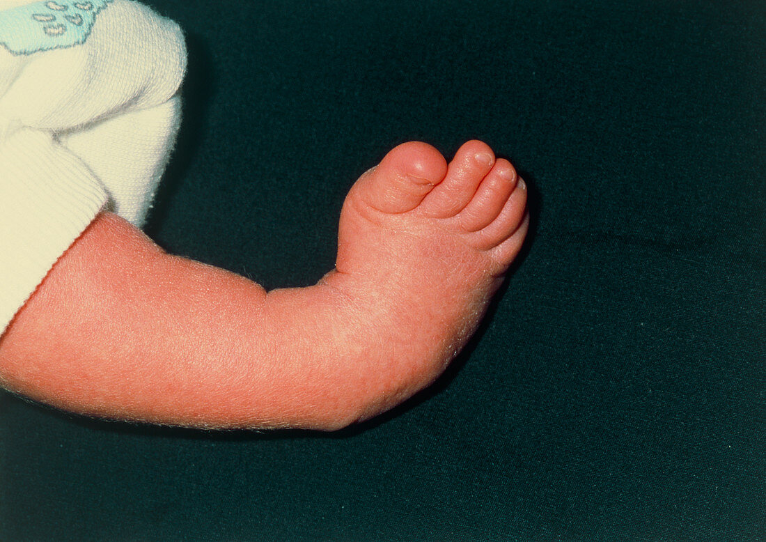 Baby with club feet (Talipes equinovarus)