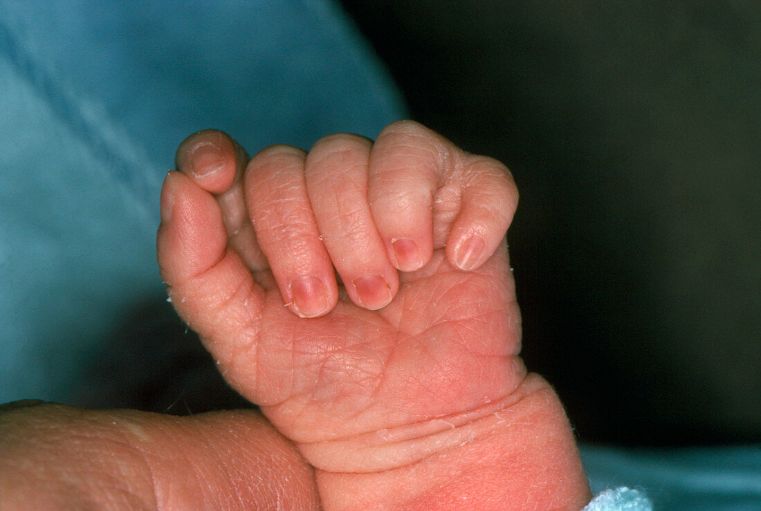 Infant's hand showing six fingers