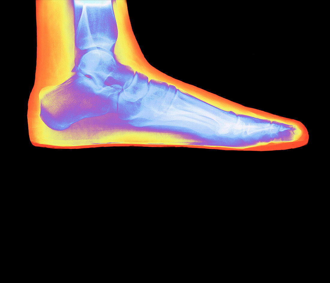 Coloured X-ray of a woman's flat foot