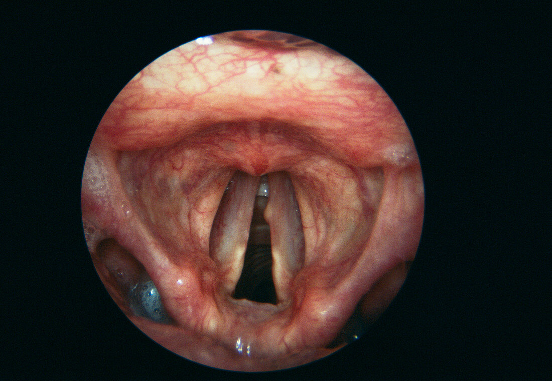 Vocal cord nodule