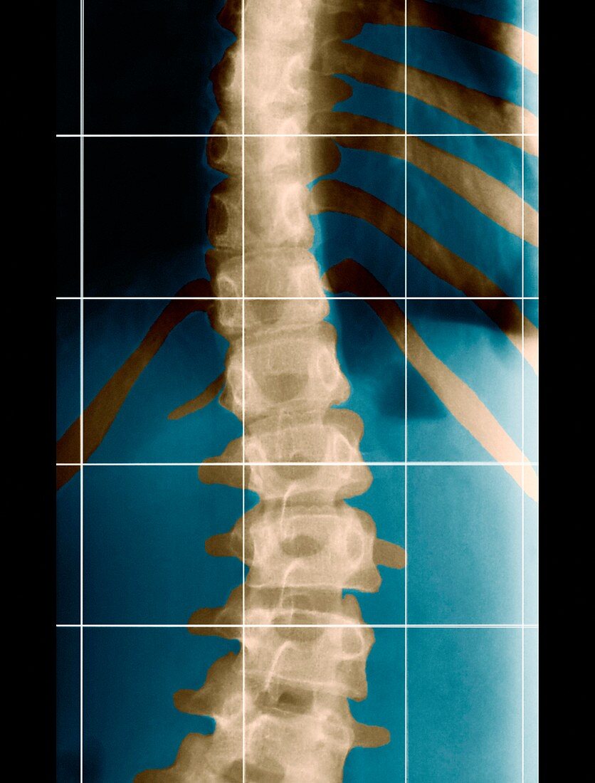 Scoliosis of the back,X-ray