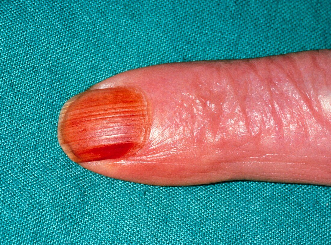Nicotine stain on fingernail of a cigarette smoker