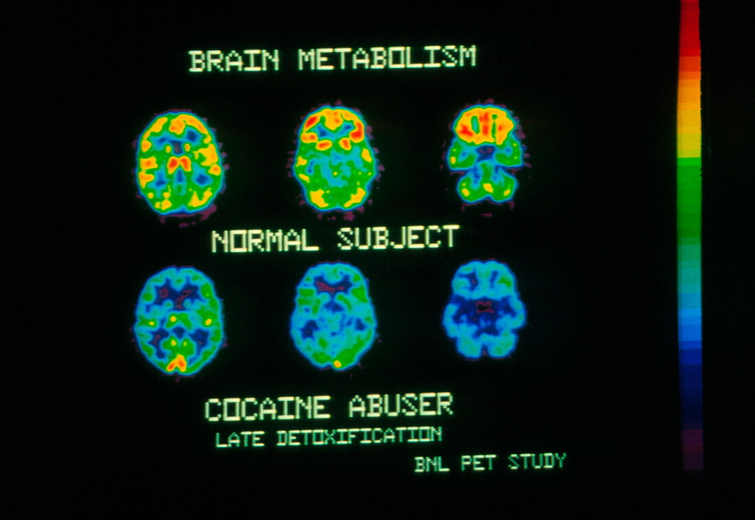 Coloured PET scans of an ex-cocaine user's brain