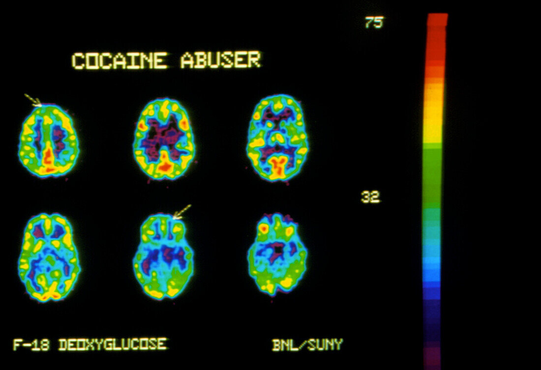 PET scans of brain of a cocaine user