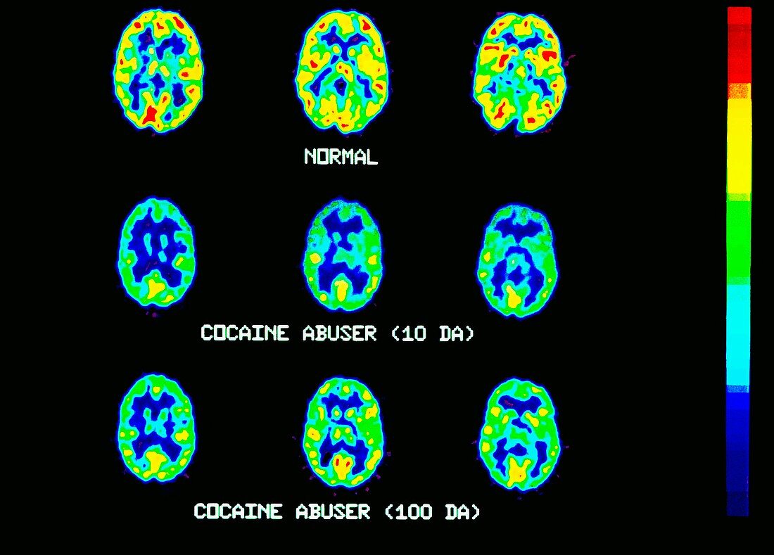 Cocaine use,PET brain scans