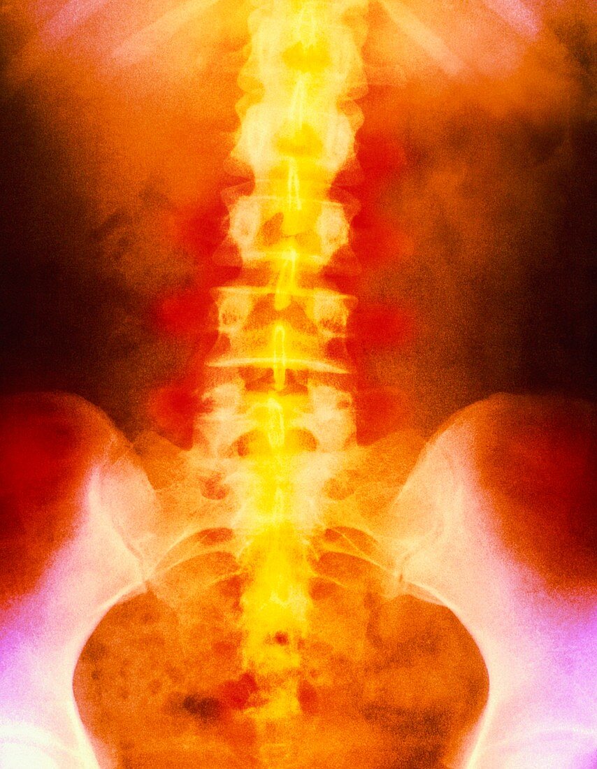 Coloured X-ray depicting pain in the lower spine