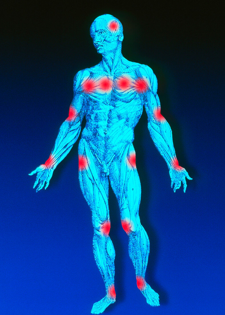 Male figure depicting pain points in fibromyalgia