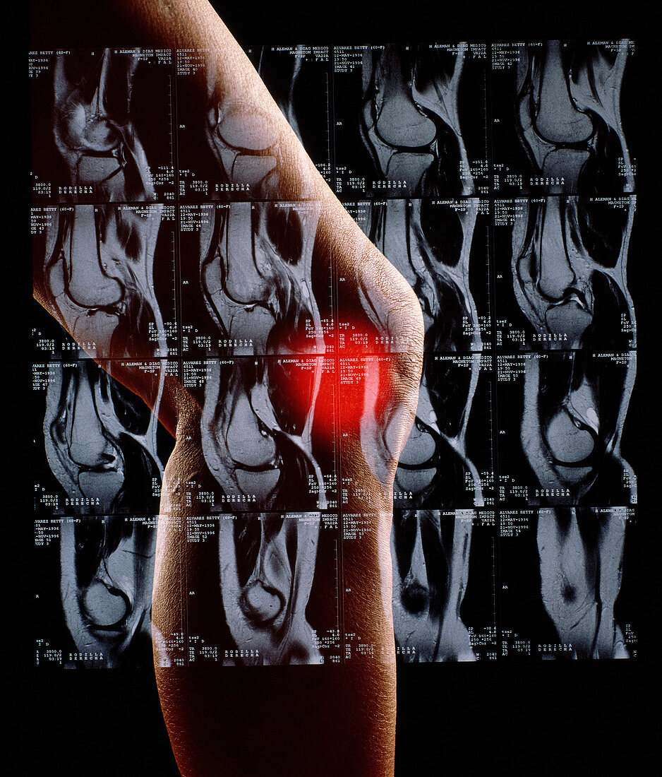 Woman's knee depicting pain,with MRI sca