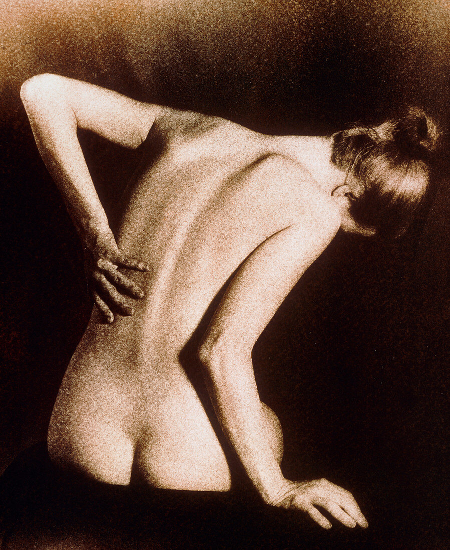 Posterior view of naked woman with back pain