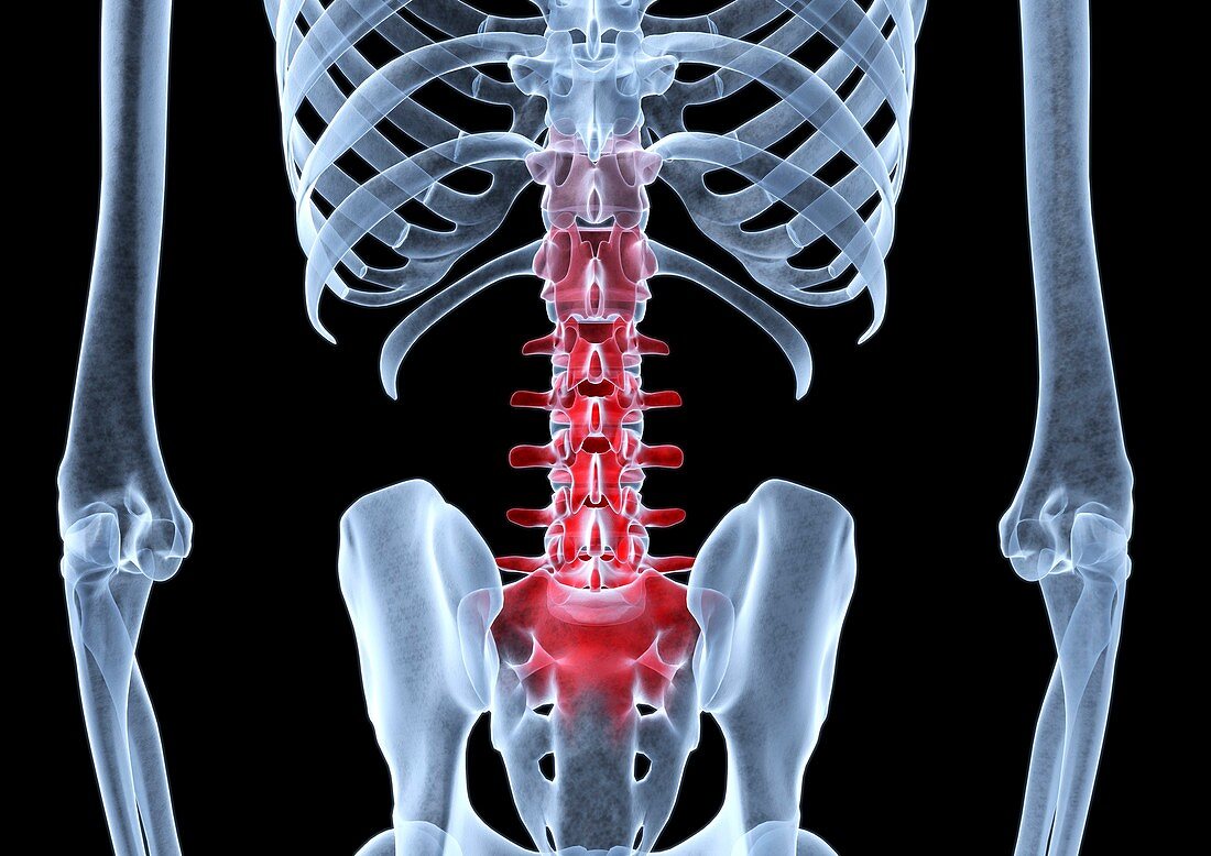 Lower back pain,X-ray artwork