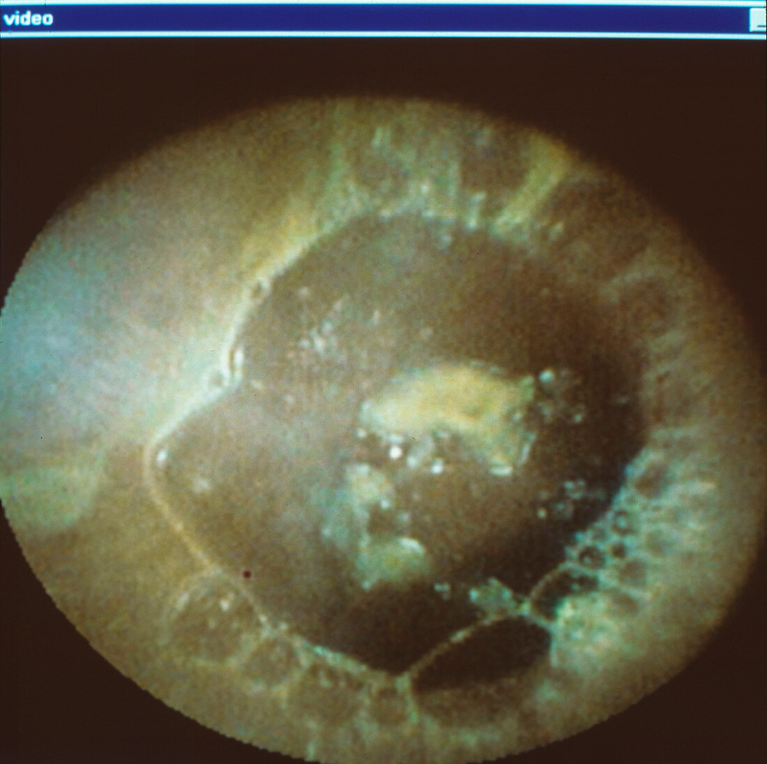 Small intestine endoscope view