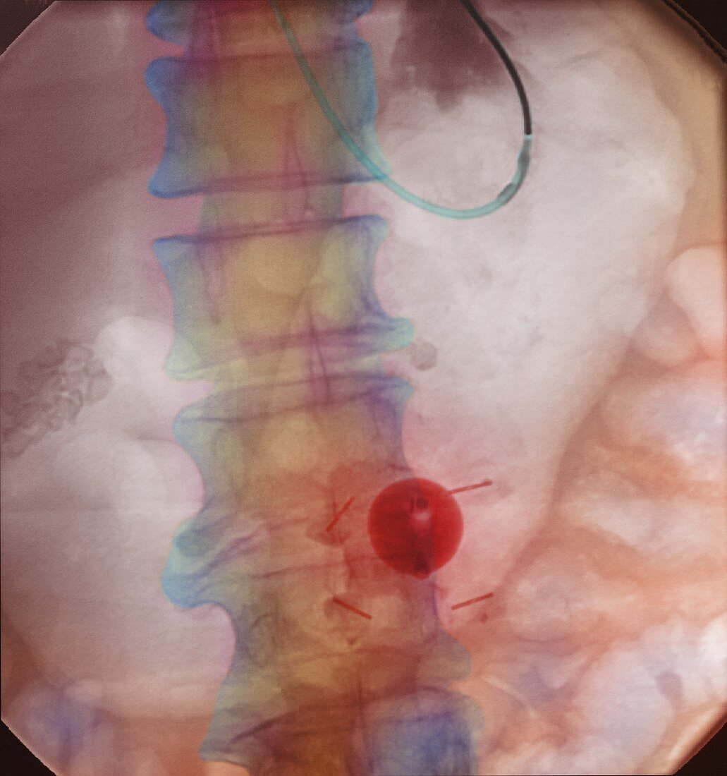 Gastrostomy,X-ray
