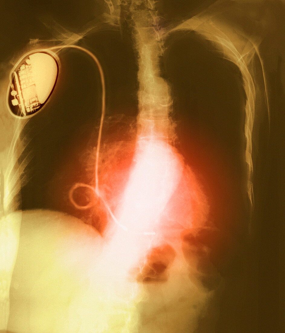Chest X-ray showing heart pacemaker