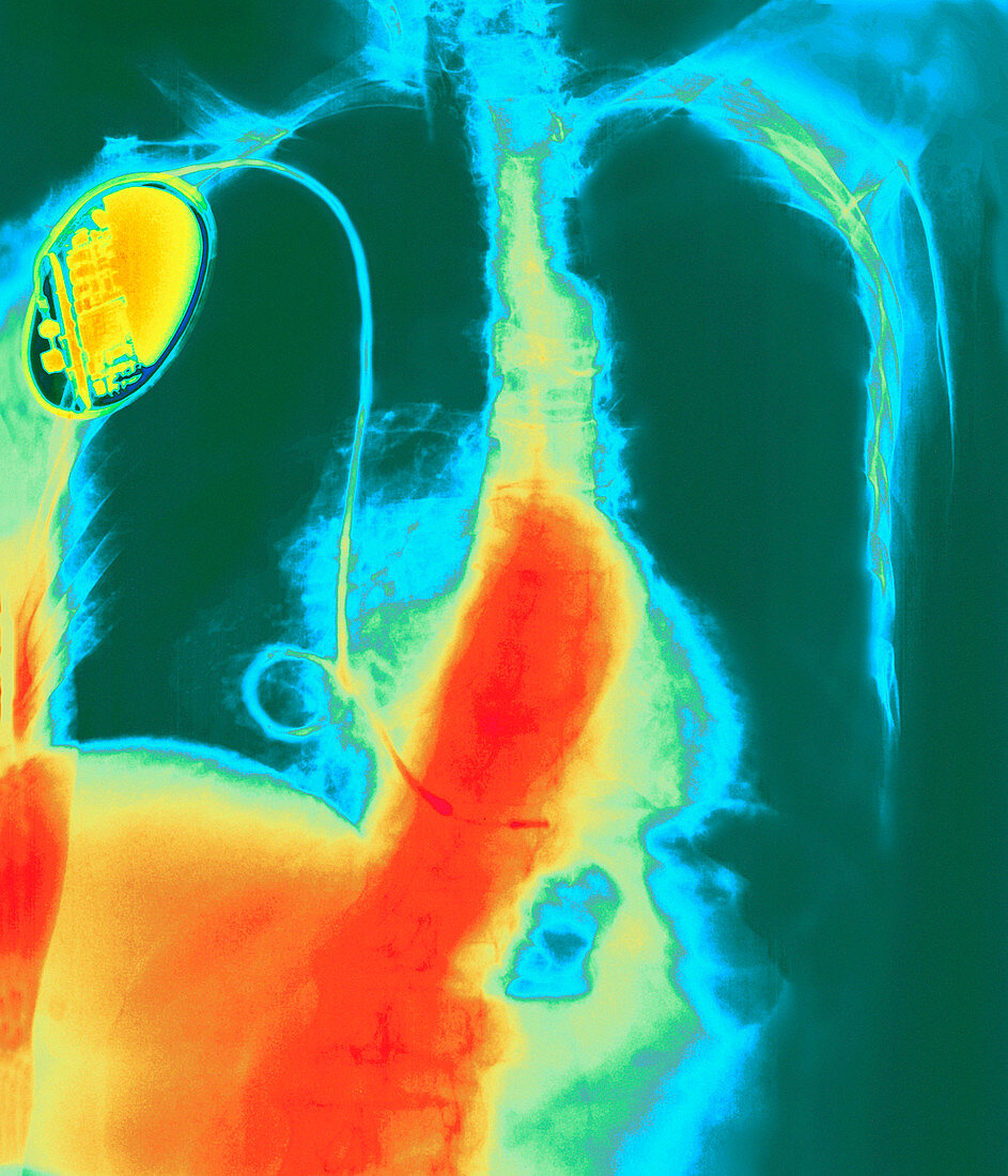 Coloured chest X-ray showing heart pacemaker