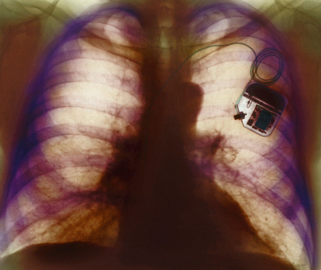 Heart pacemaker X-ray
