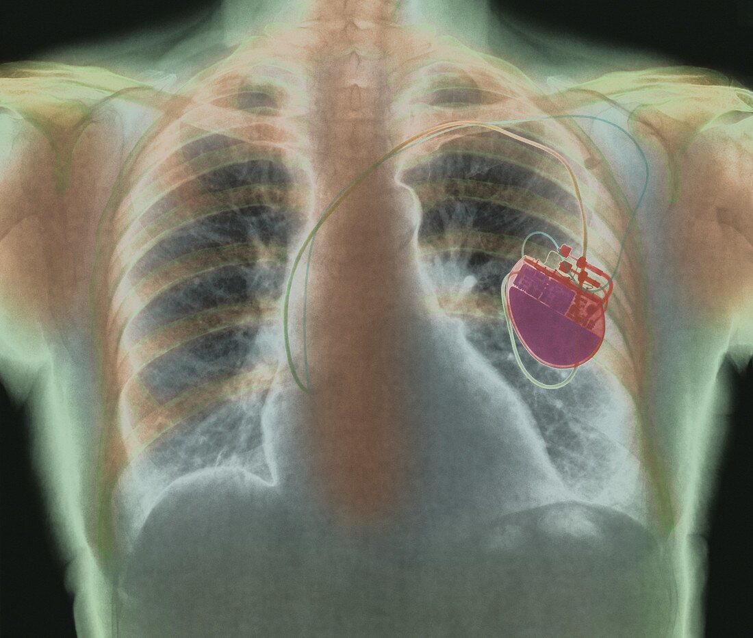 Heart pacemaker,X-ray