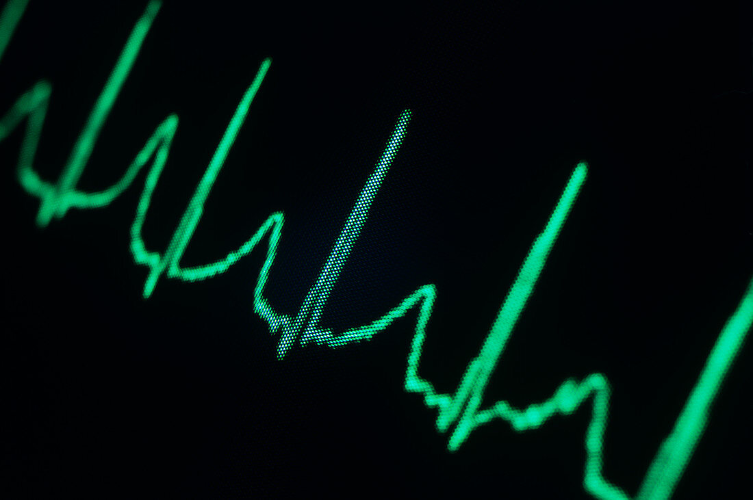 ECG of a normal heart rate