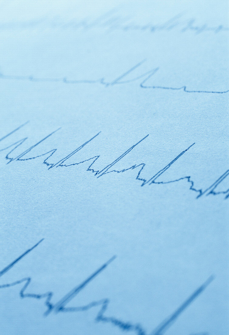 ECG of a normal heart rate