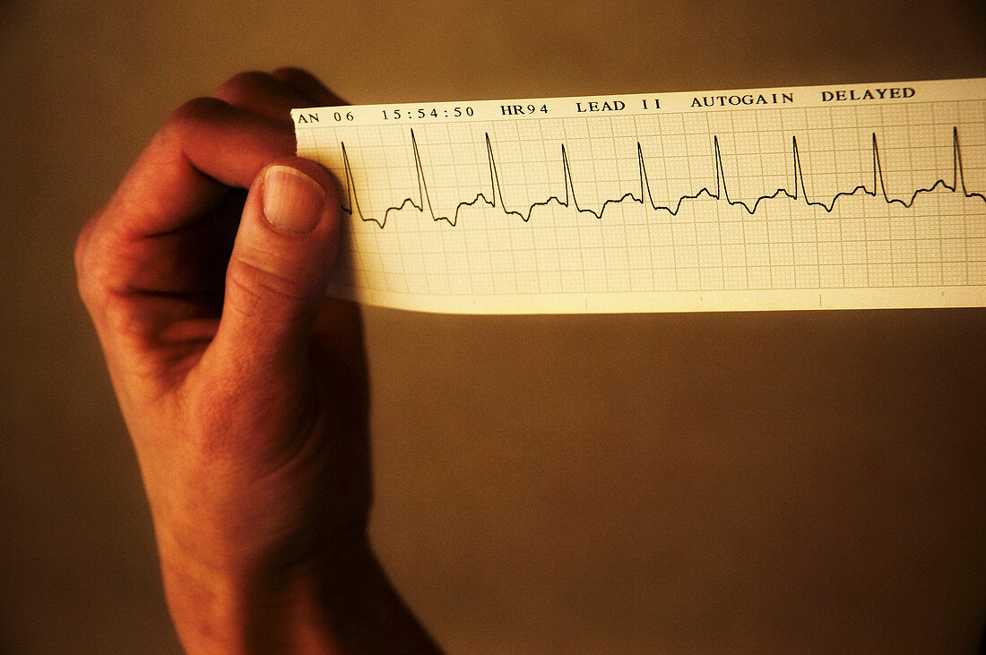 ECG of a normal heart rate