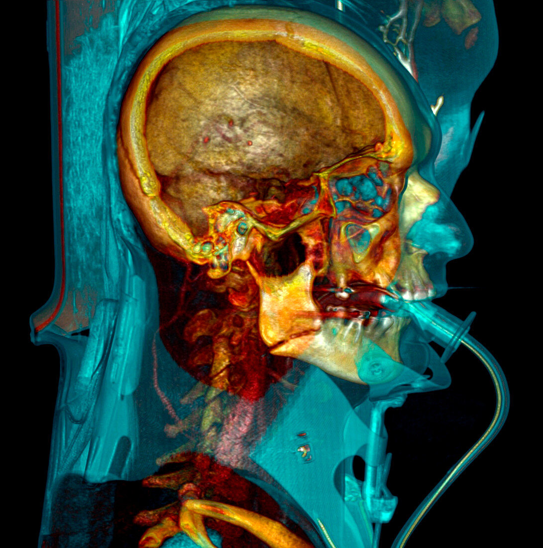 Intensive care patient,CT scan
