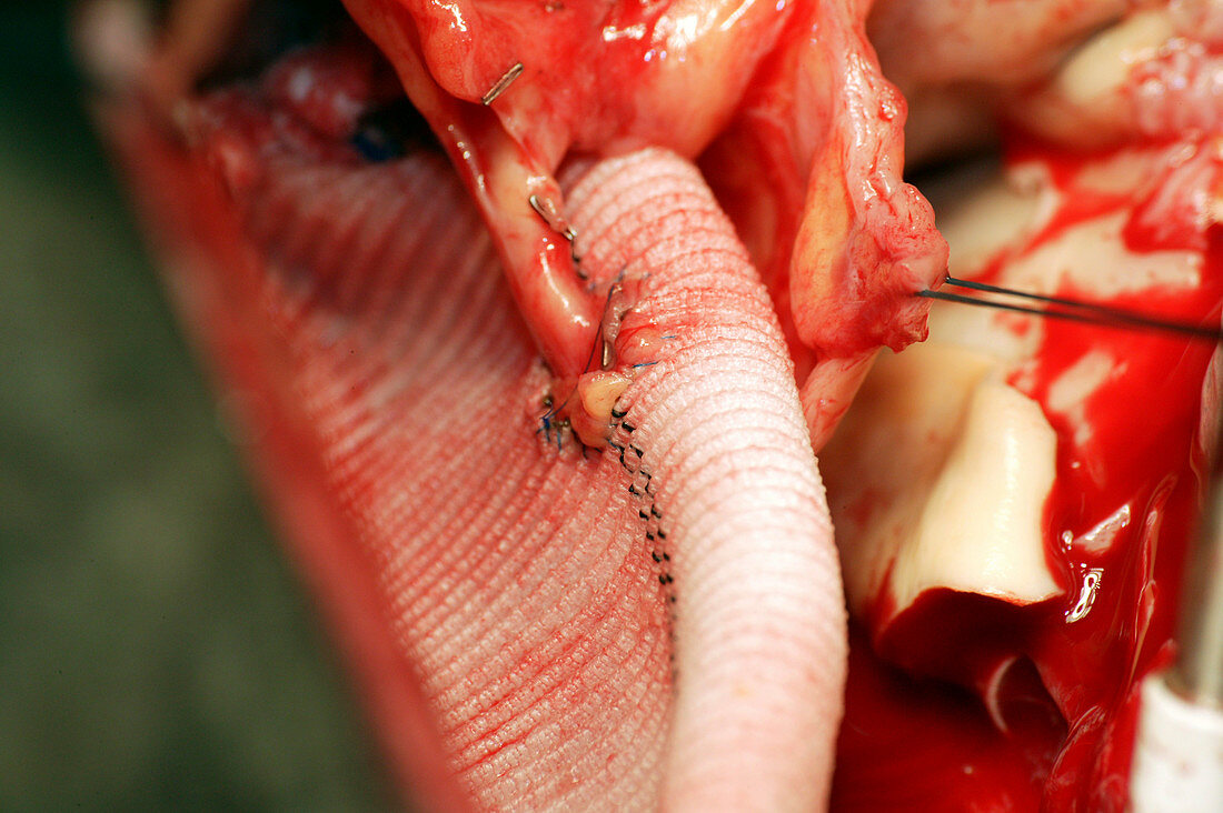 Aorta surgery