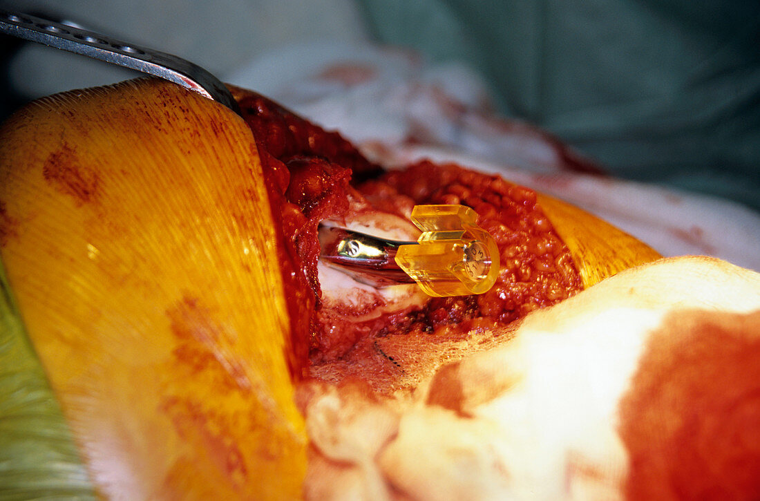 Hip replacement surgery