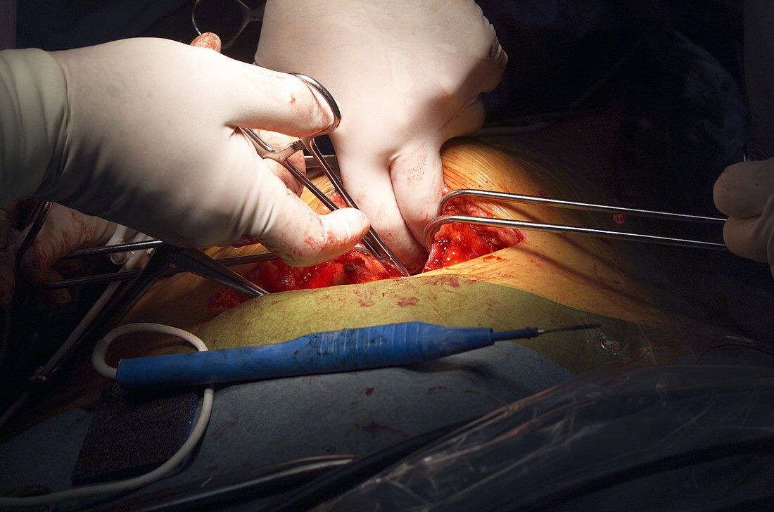 Bowel surgery