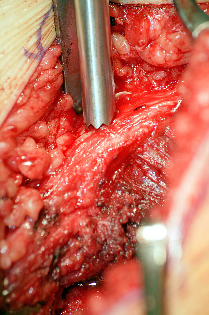 Surgery to remove a tumour in the pelvis