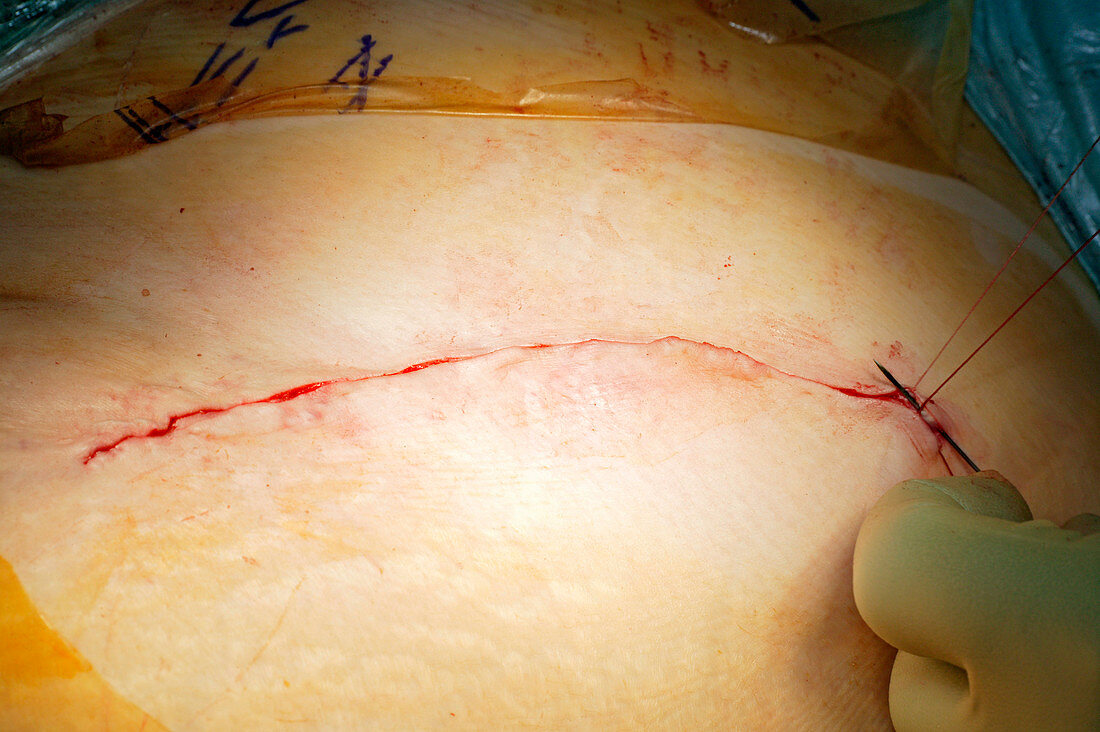 Surgery to remove a tumour in the pelvis