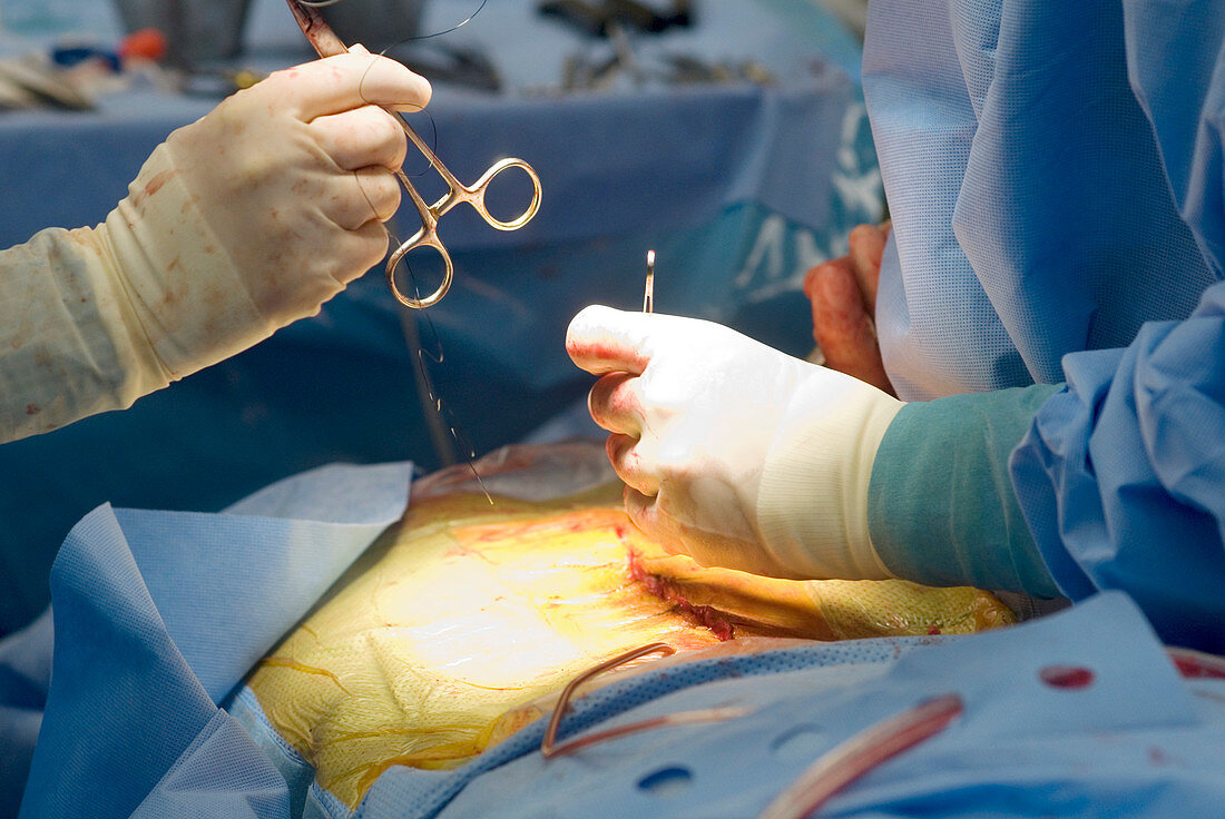 Spinal surgery