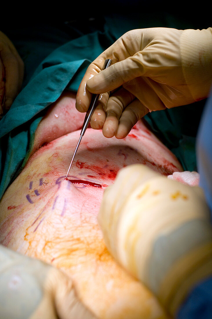 Varicose vein surgery