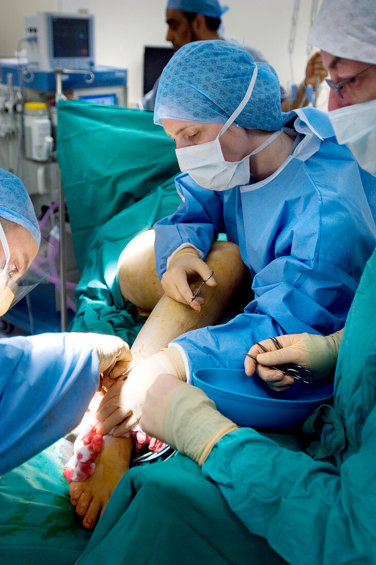 Varicose vein surgery