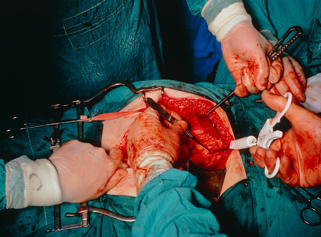 Close-up of hysterectomy surgery in progress