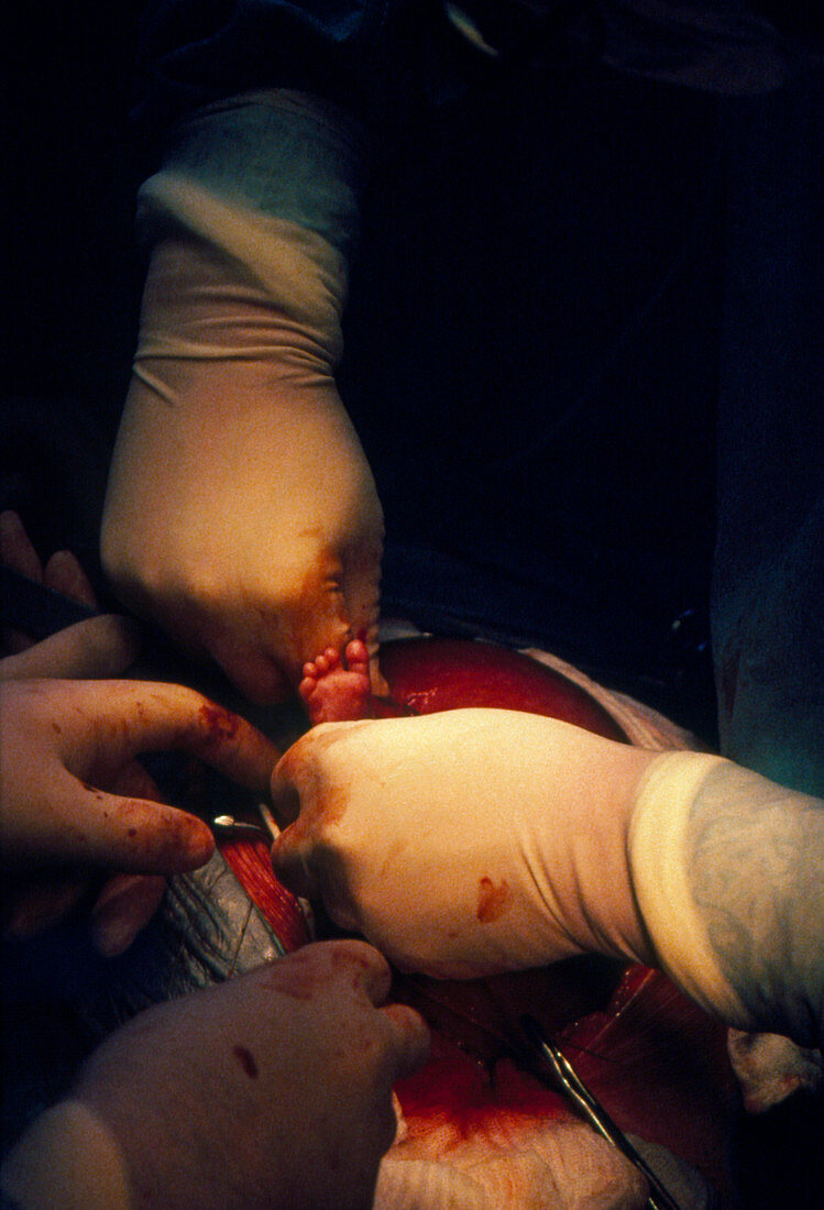 Open uterus fetal surgery: reintegration in uterus