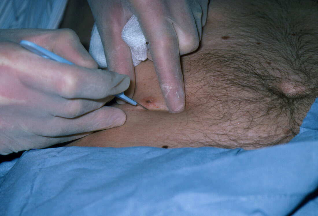 Close-up of the excision of a mole