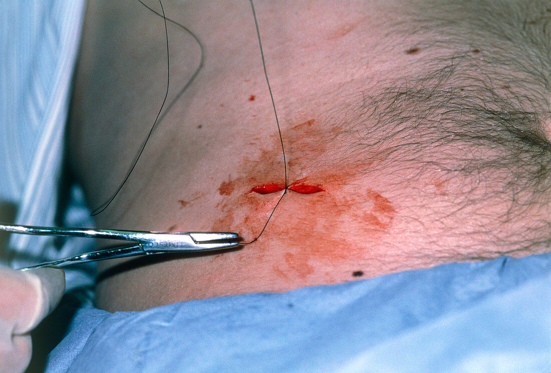 Doctor suturing an incision after a mole removal