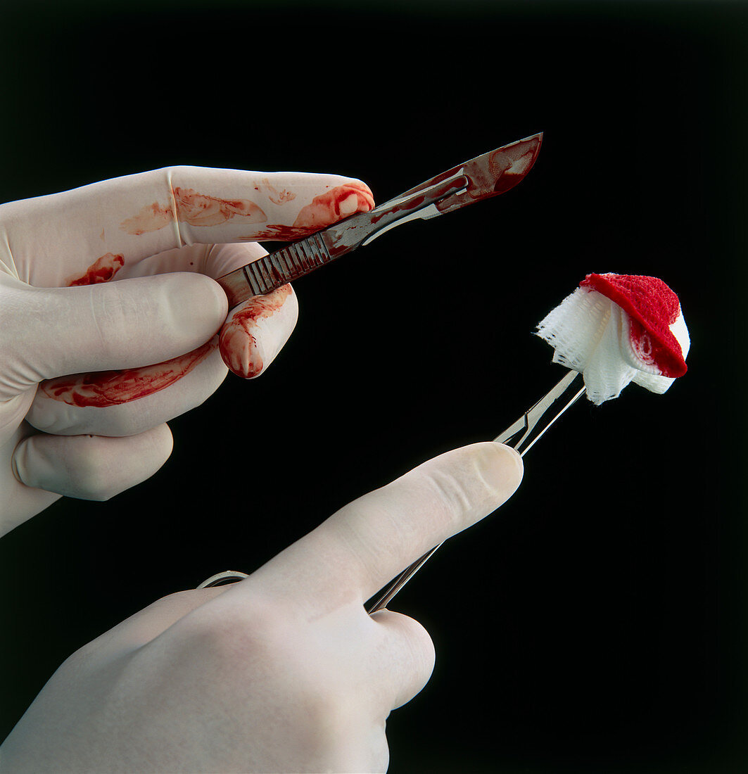 Gloved hands with bloody scalpel and gauze