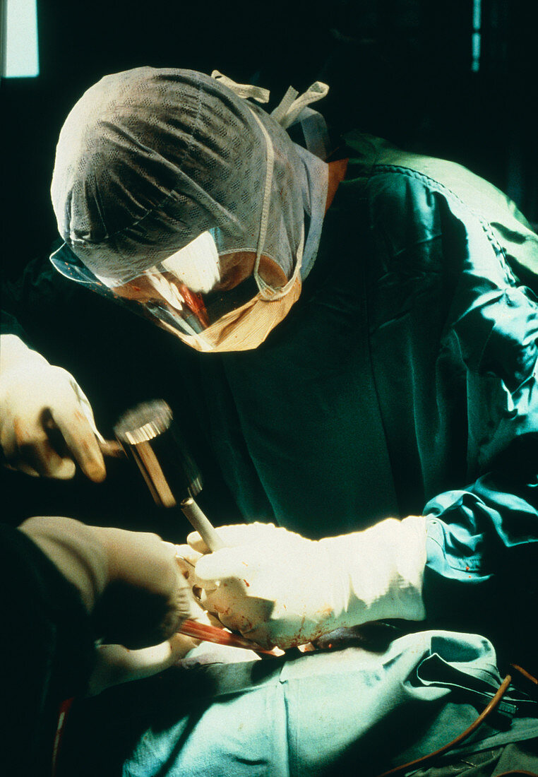 Surgeons perfoming hip replacement surgery