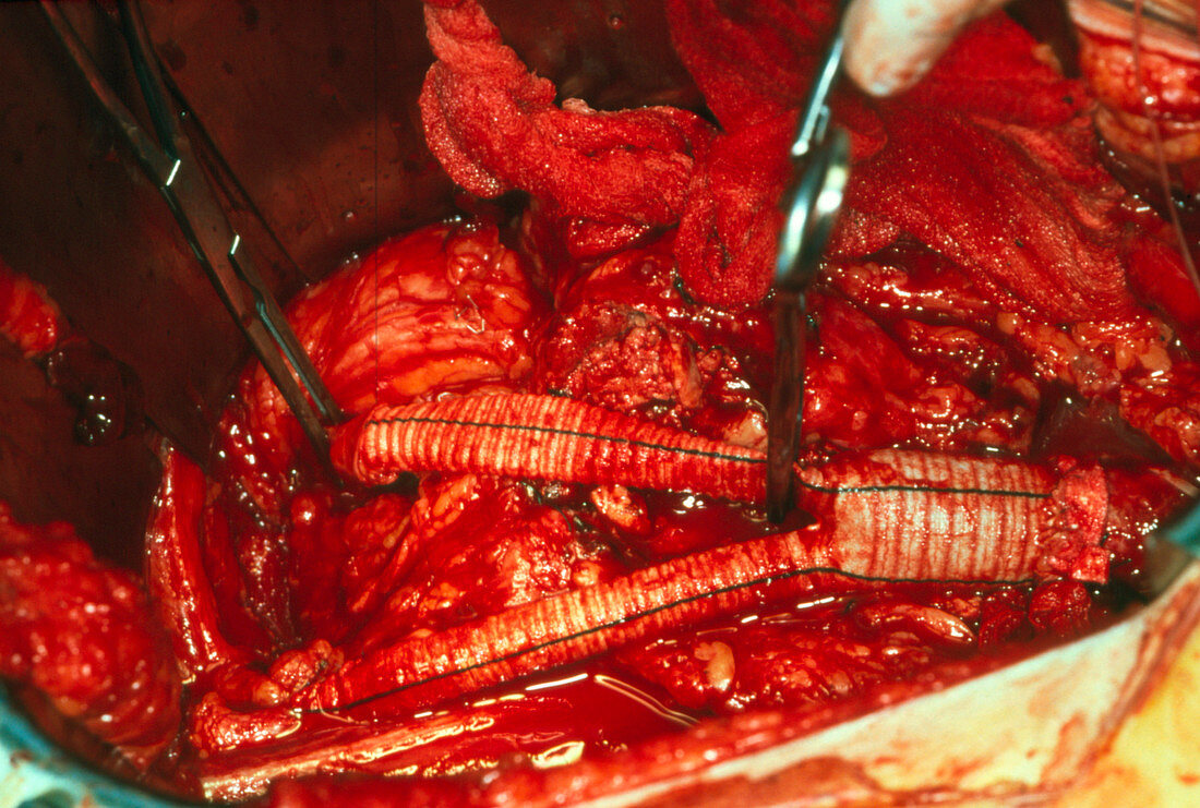 Surgery to replace an aneurysm of the aorta